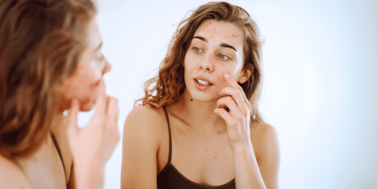 Acneea hormonală: cauze, simptome și soluții